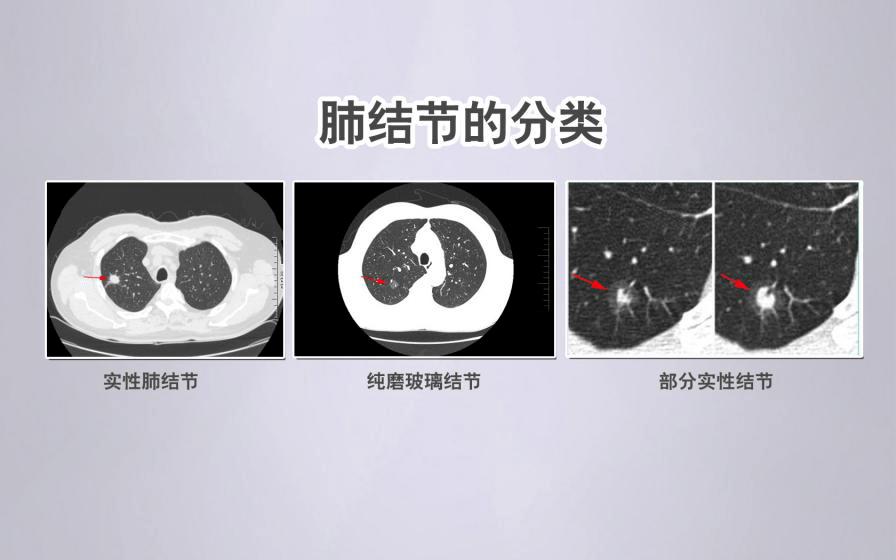 【合肥长淮中医医院】肺结节和肺癌什么关系？